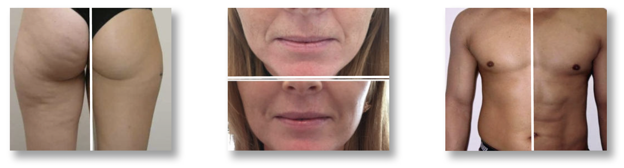 Ultrasuoni ed estetica | Sanotech