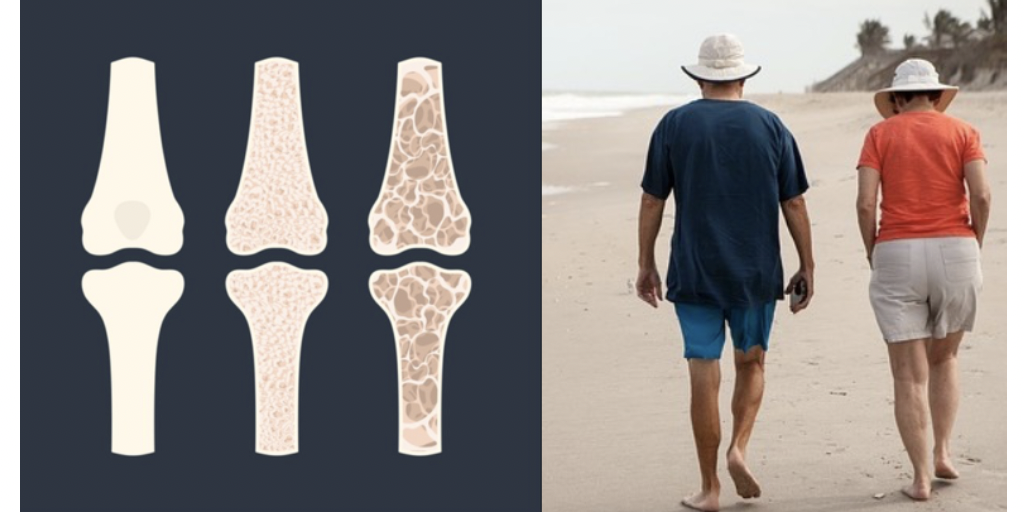 osteoporosi1