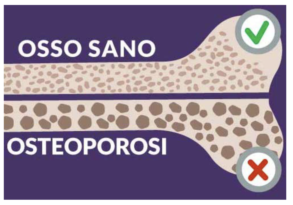 osteoporosi4