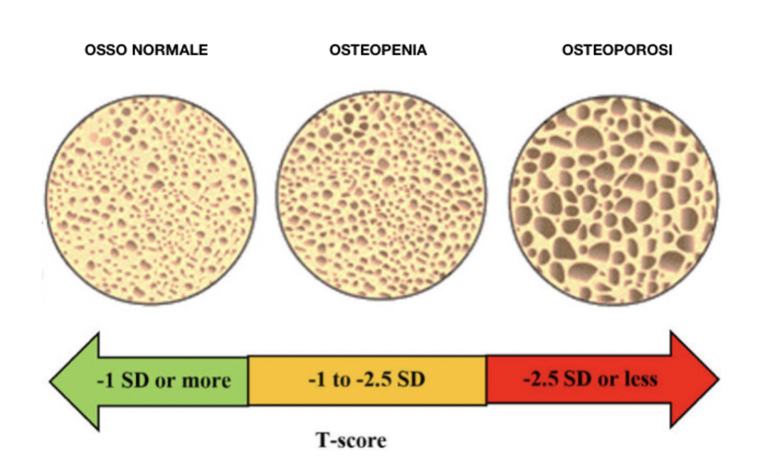 osteoporosi5