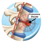 Protusione discale